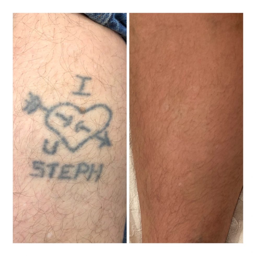 Laser Tattoo Removal Before & After Photos Vanish Laser
