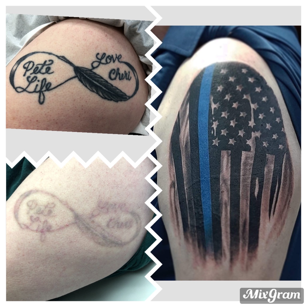 Laser Tattoo Removal Before & After Photos Vanish Laser