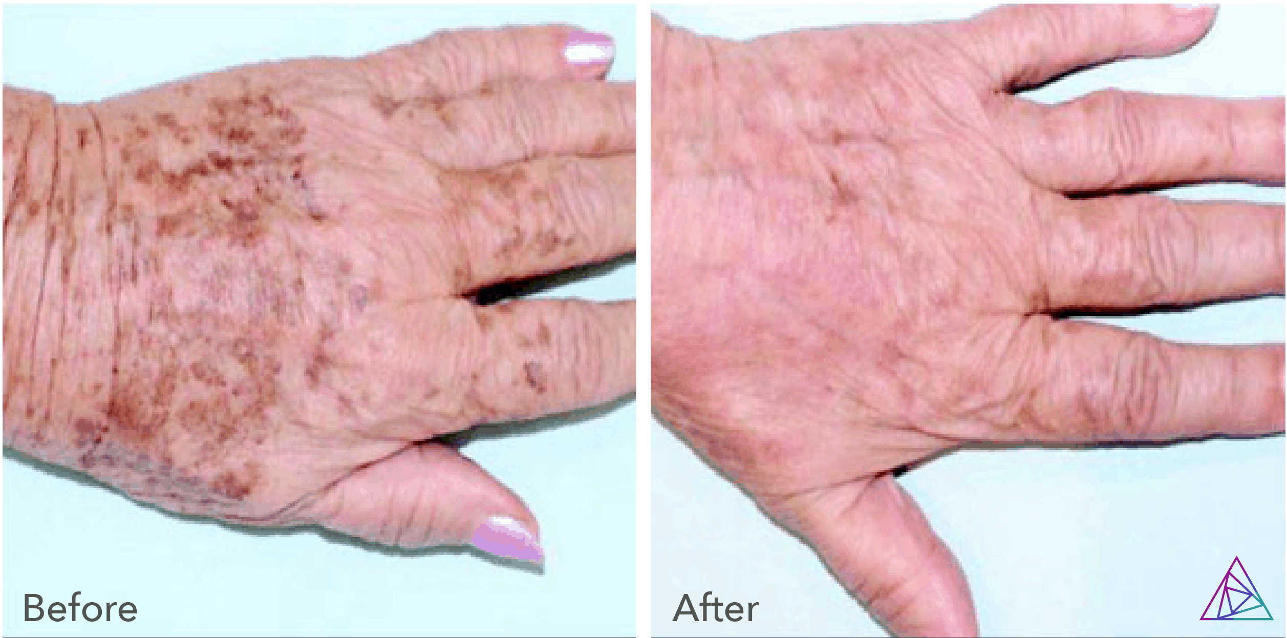 Pigmented Lesion Removal Vanish Laser Clinic Alexandria VA