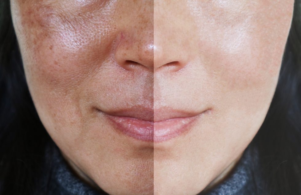IPL Photo Rejuvenation Vanish Laser & Skin