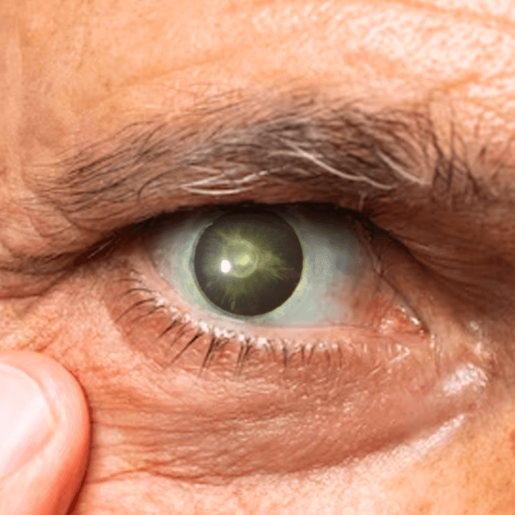 Posterior Subcapsular Cataract Vasan Eye Care