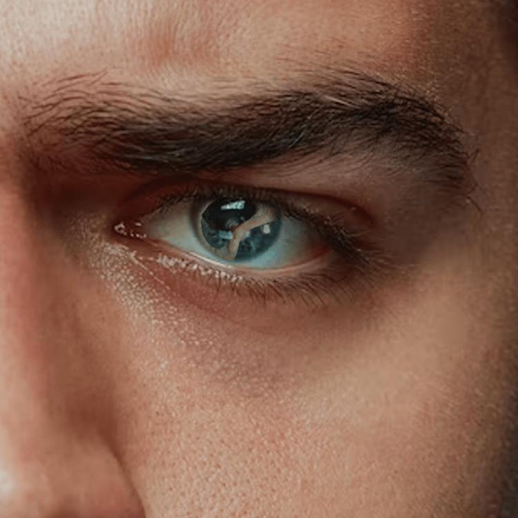 Traumatic Cataract Vasan Eye Care