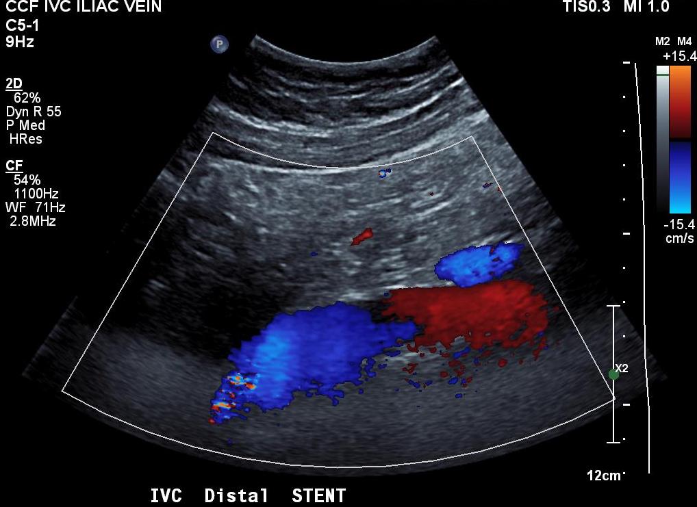 POTS+MayThurner’s Syndrome Rare Disease Causes Rare Disease? A