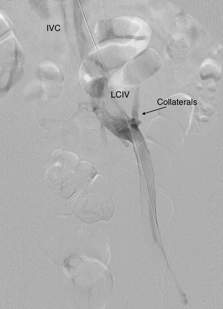 POTS+MayThurner’s Syndrome Rare Disease Causes Rare Disease? A