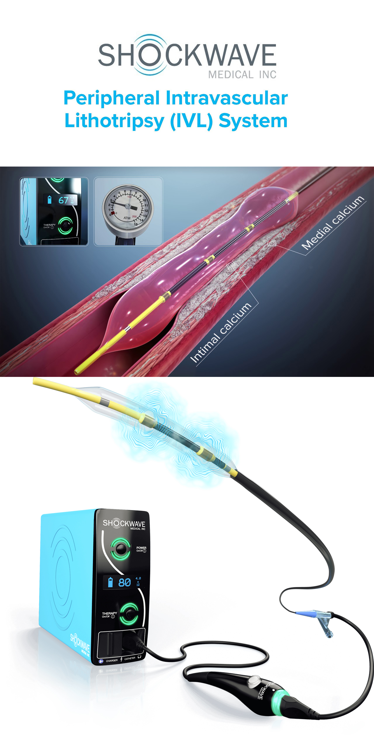 Shockwave lithotripsy Vascular ART
