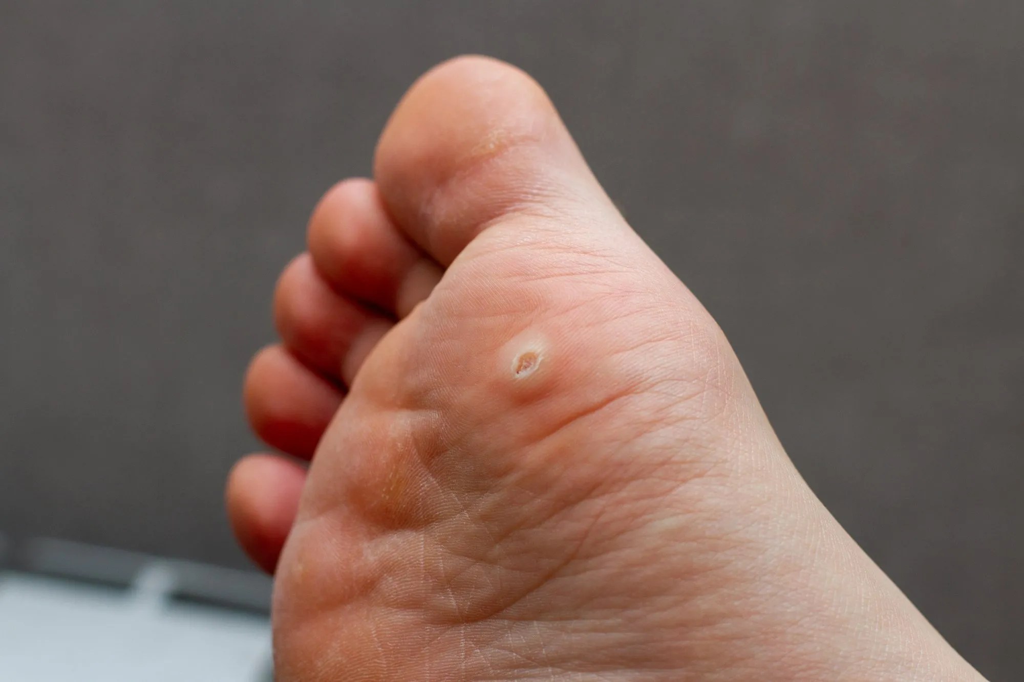 Diabetic Foot Care Dr. Sravan