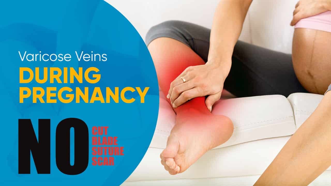 Varicose Veins in Pregnancy Vascular Interventions