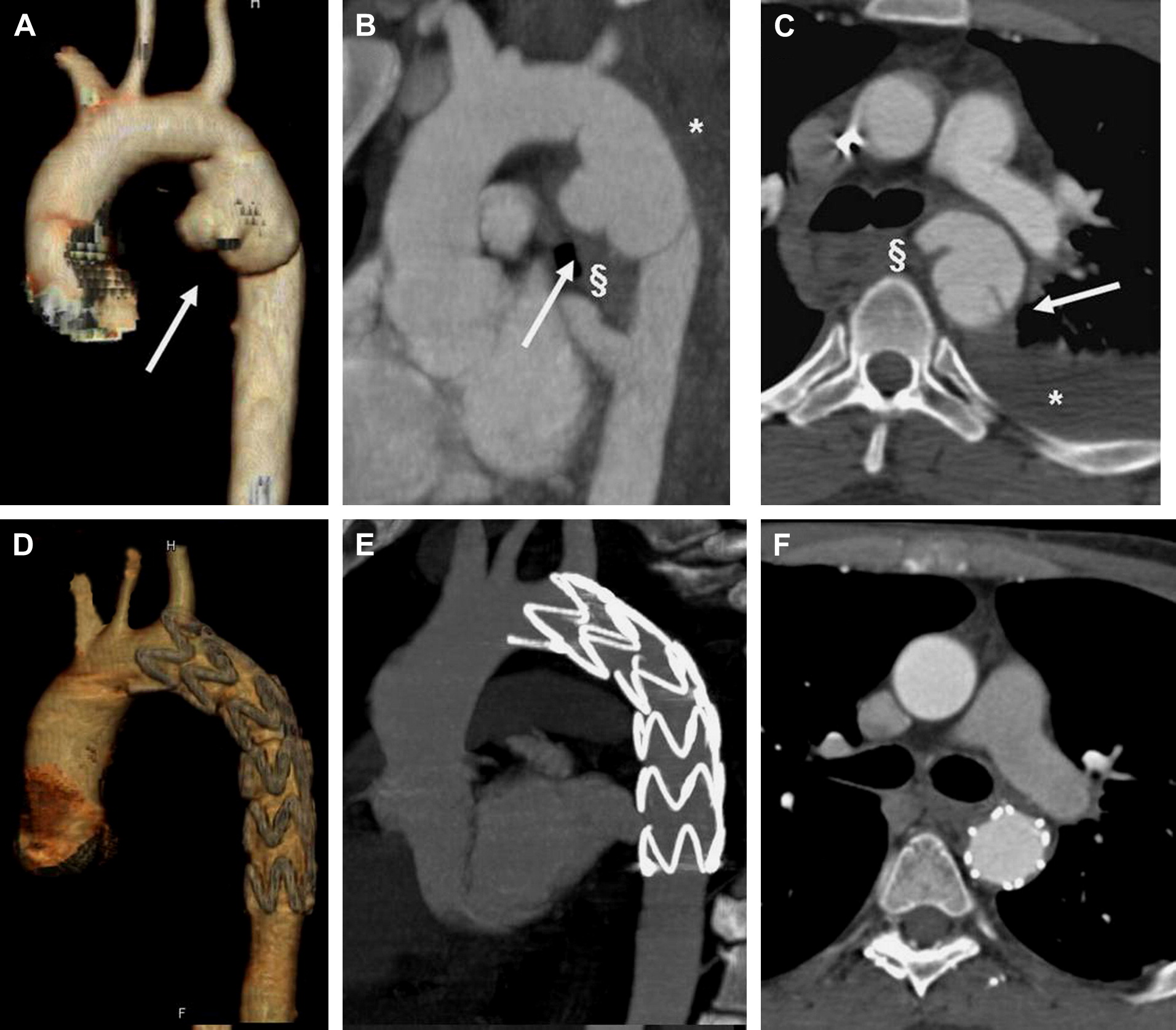 Delayed management of Grade III blunt aortic injury Series from a