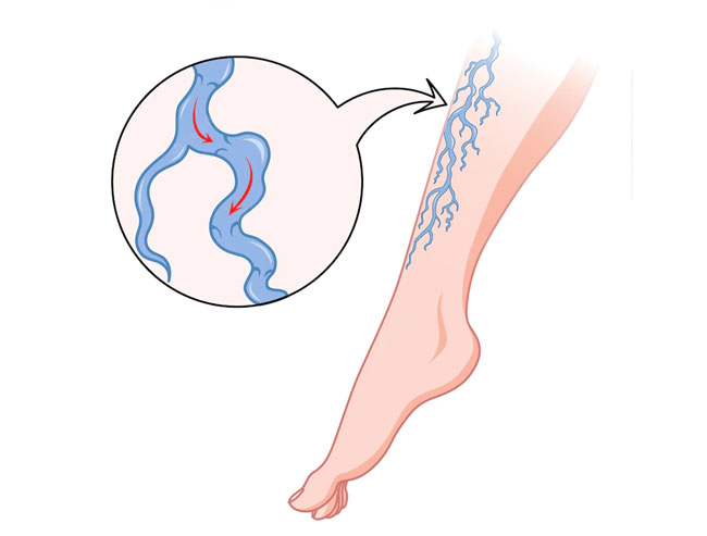 Blood Circulation Problem in Leg Dr. Ahsan Ali