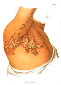 Herpes zoster was described as early as 1867, as can be seen in the lithograph from the Atlas der Hautkranheiten, although the connection with chickenpox didn't come until later.