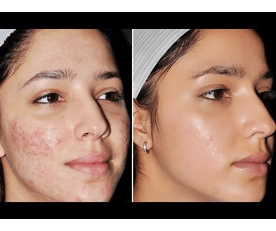 DIY HOMEMADE ACNE FACE MASKS V Beautify