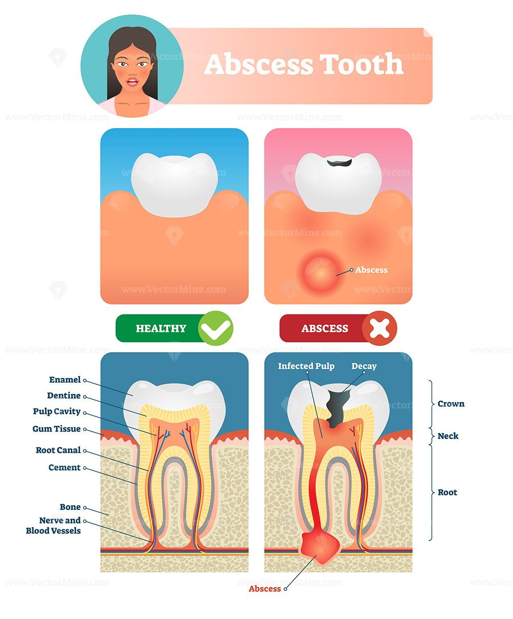 Abscess tooth vector illustration VectorMine