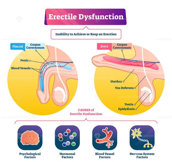 Erectile dysfunction vector illustration VectorMine