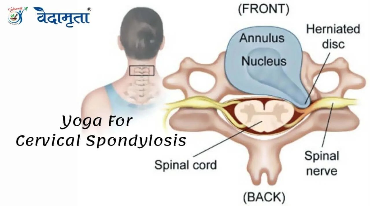 Yoga for Cervical Spondylosis Top 3 New Tip Yoga Therapy