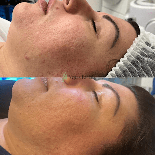 Microneedling Face & Neck Treatment Vegas Facials