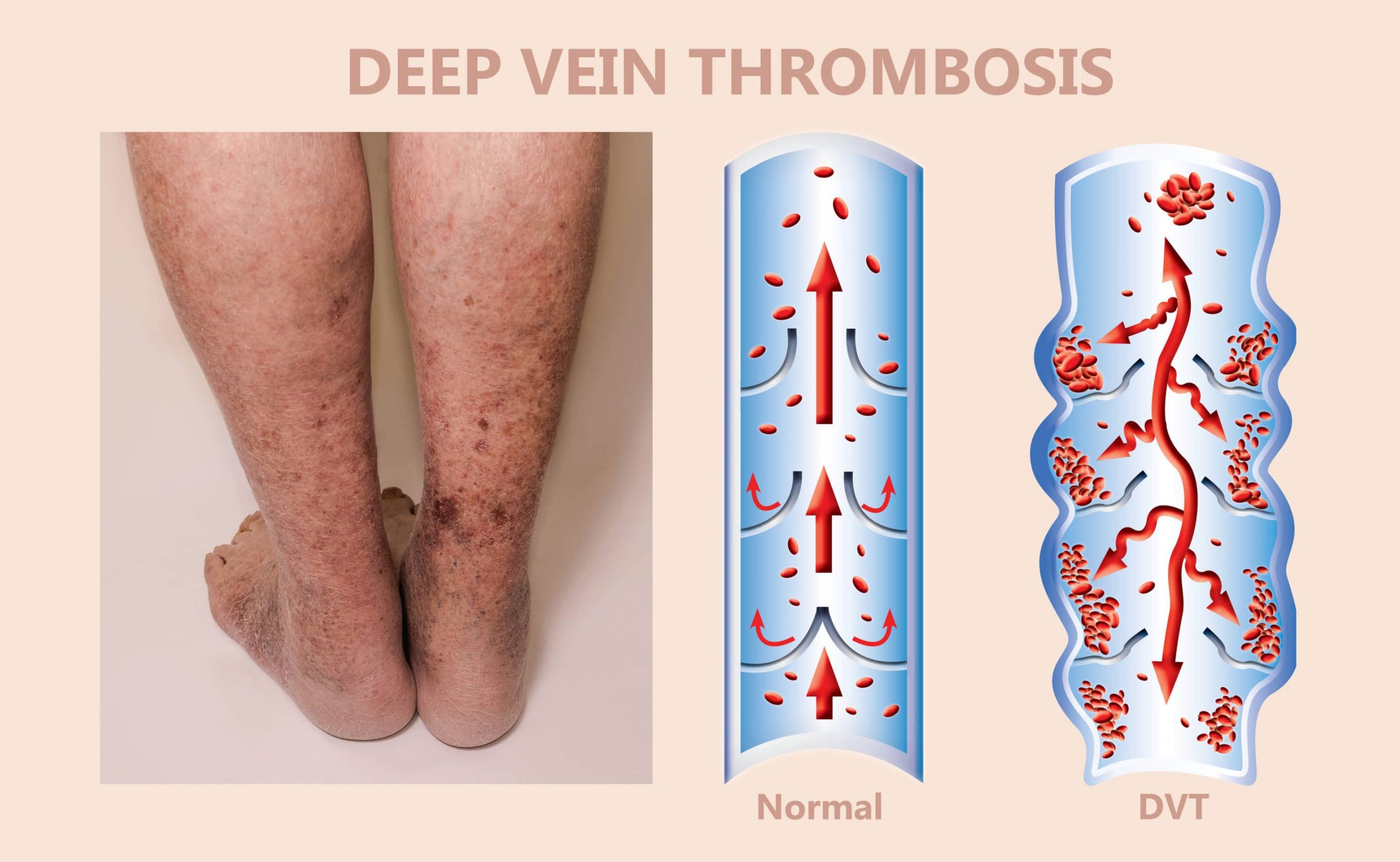 Deep Vein Thrombosis (DVT) Vein Specialist of the Carolinas