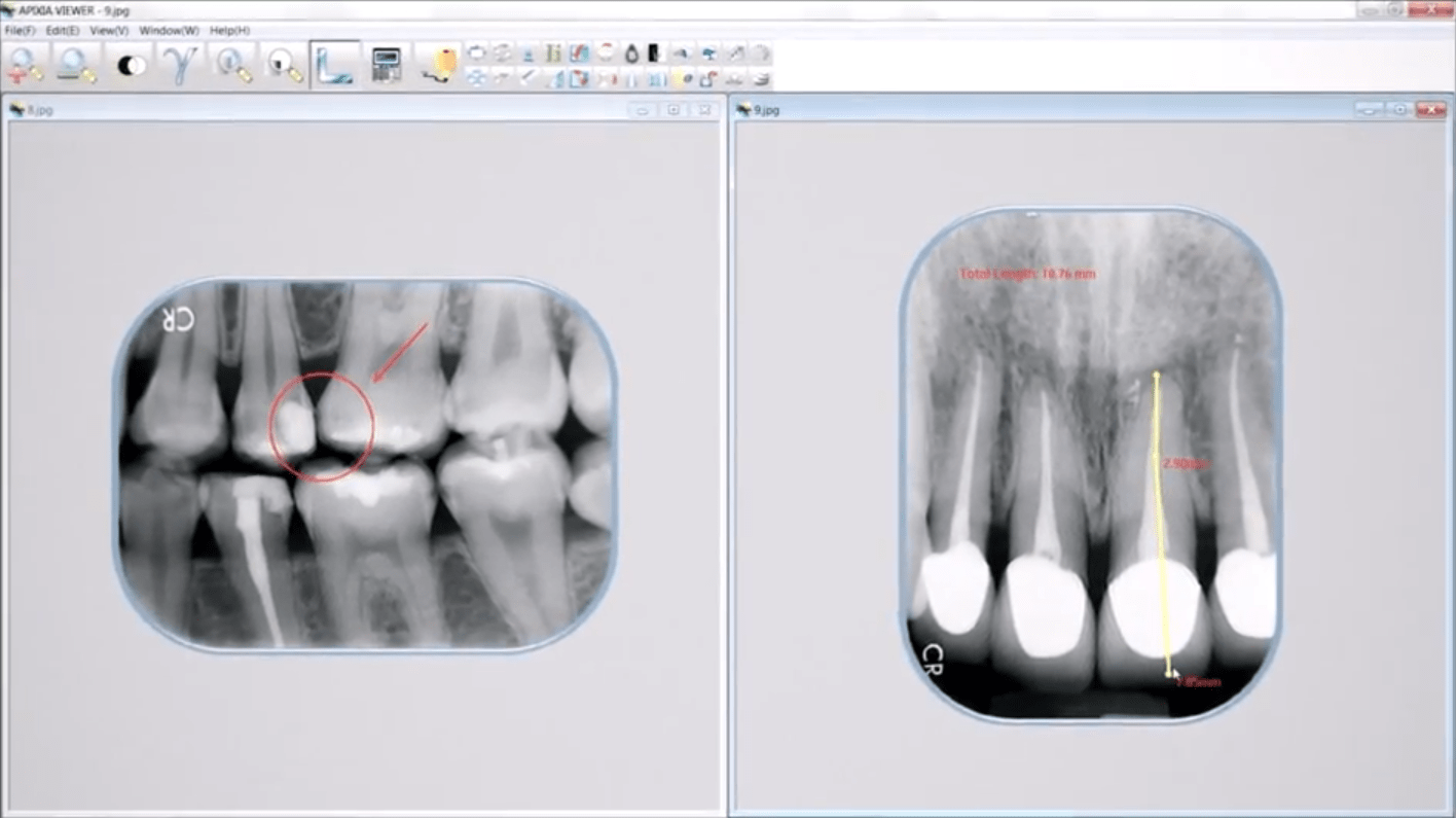 Apixia Digirex Dental Phosphor Plate (PSP) Digital XRay Scanner