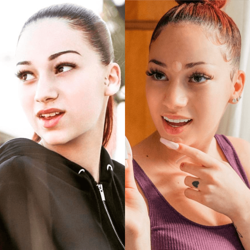 Bhad Bhabie New Smile Dental Veneers transformation Dental Veneers