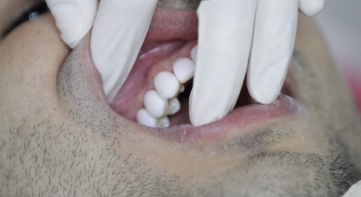 How long does dental veneers last? Matizz Veneers Official