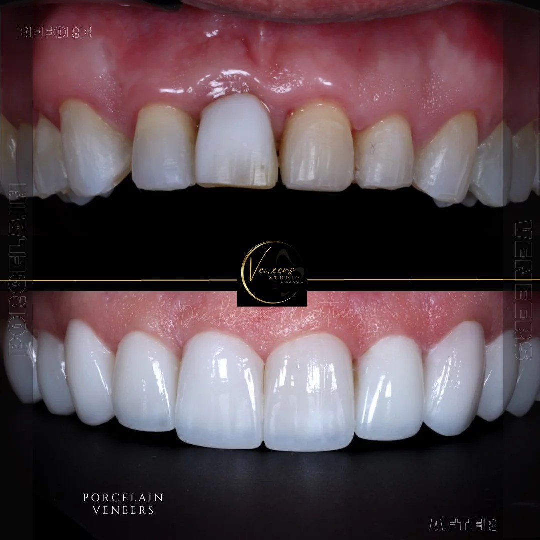 Porcelain Veneers veneers in colombia