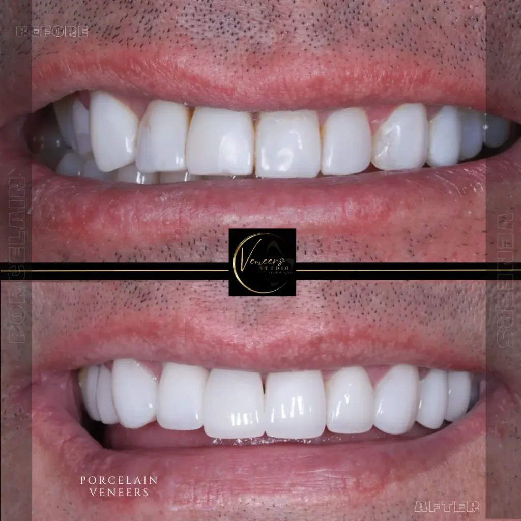 Veneers in Colombia Medellin & Cartagena Hotel included