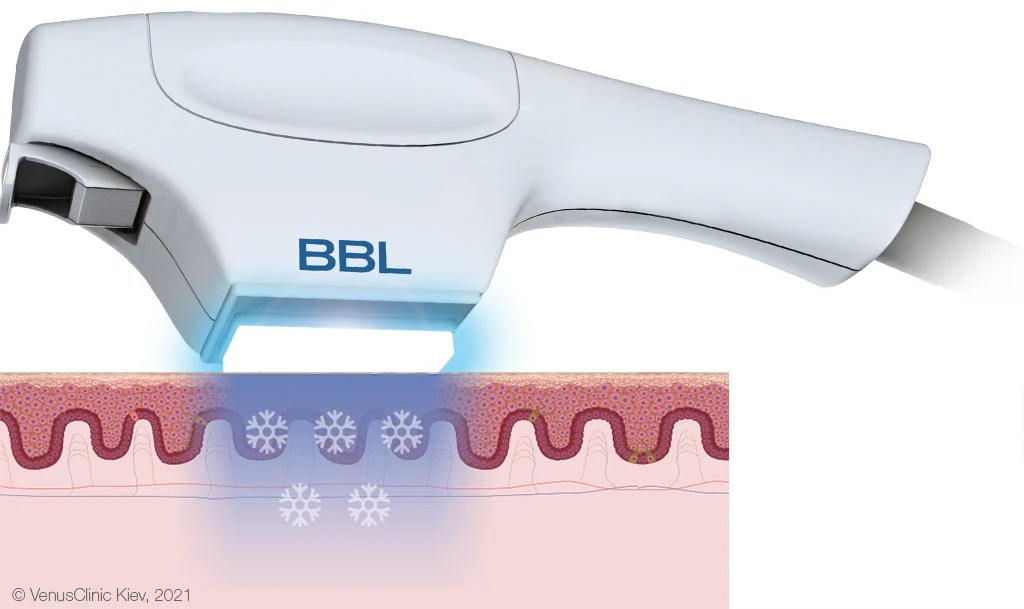 What does BBL technology mean and how does it work? Venus Clinic EN