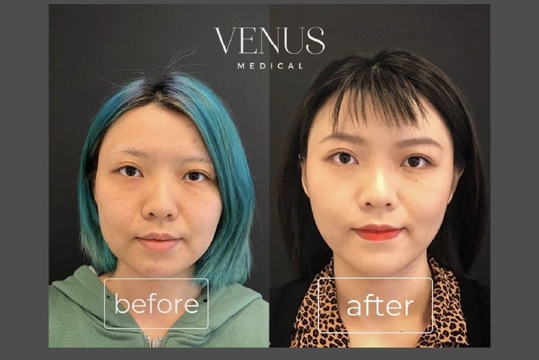 Buccal Fat Removal Surgery Dublin Ireland Venus medical