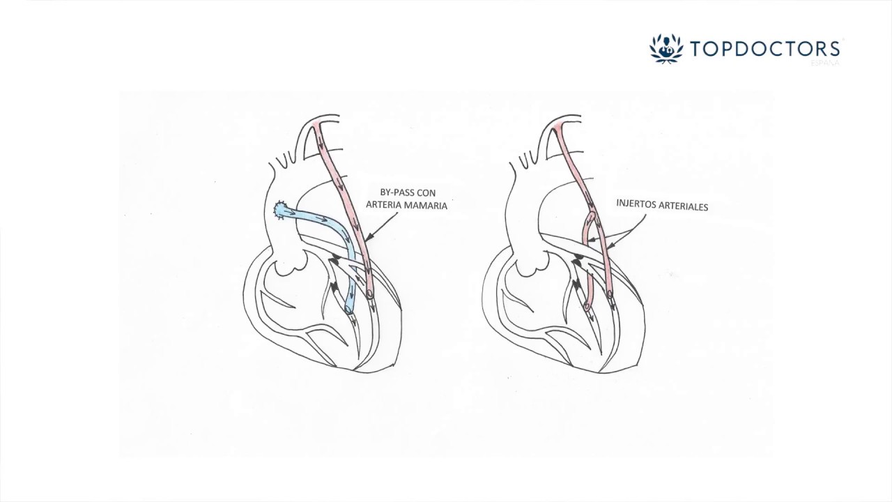 Qué Significa Bypass