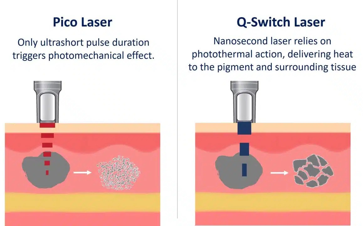 Not All Pico Lasers Are Created Equal Types of Pico Lasers