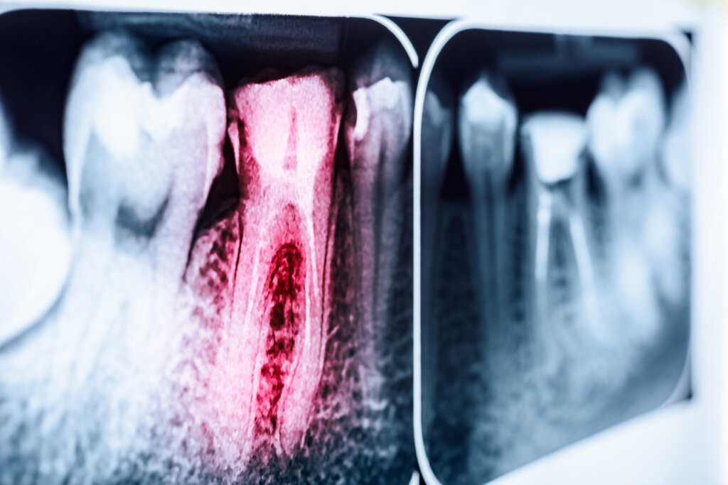 How Periodontitis Causes Tooth Decay Vero Implants