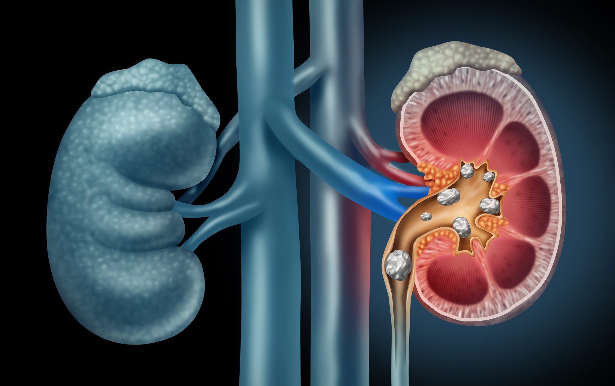 Protect Your Kidneys from Stones by Eating a Healthy Diet