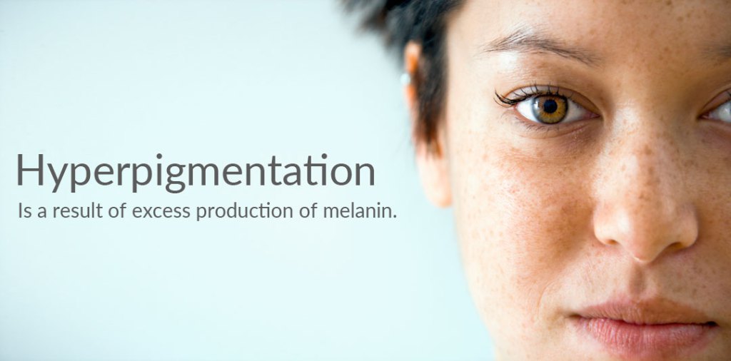 Can Exfoliation Help to Treat Hyperpigmentation? Viabuff