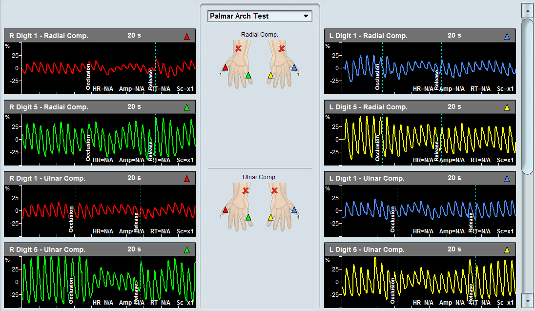 Palmar Arch Test and AV Fistula Physiologic Test Viasonix
