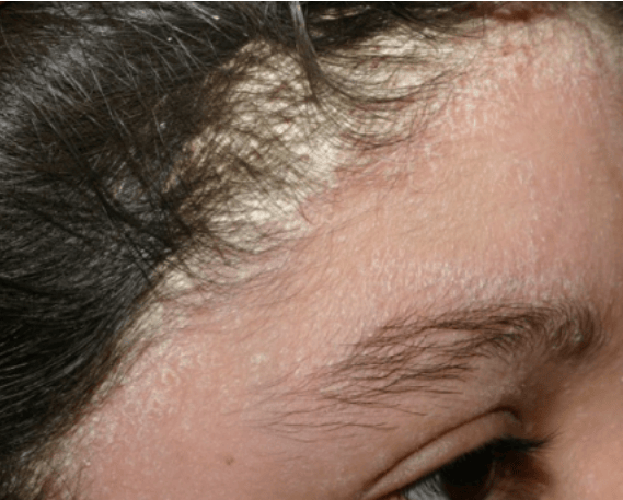 Seborrhoeic Dermatitis Scalp Seborrheic Dermatitis Foothill
