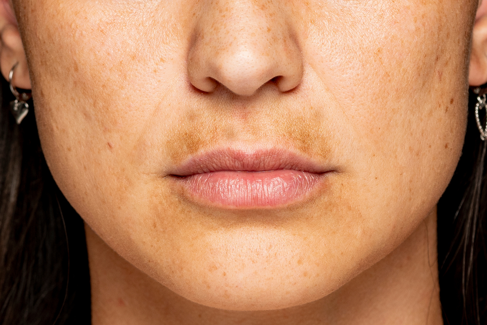 Upper Lip Melasma How Do You Get Rid of It?