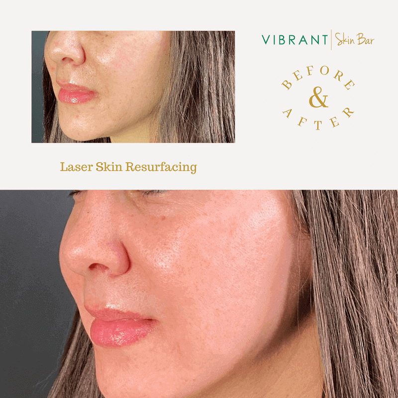 Chemical Peel Vs. Laser Which Treatment Is Best for You?