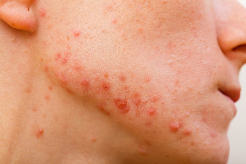 Types of Acne {Causes and Best Treatments}