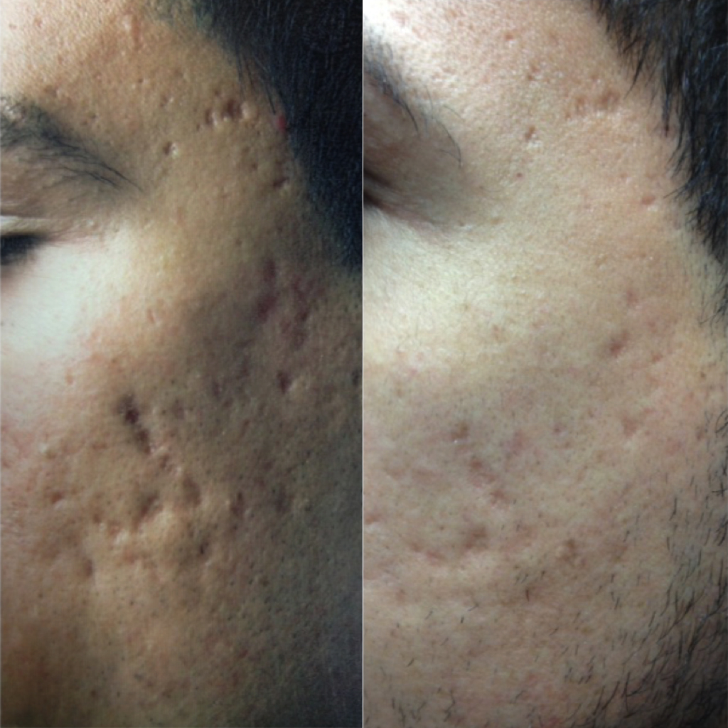 Acne Scars Victoria Park Medispa Winnipeg Manitoba Canada