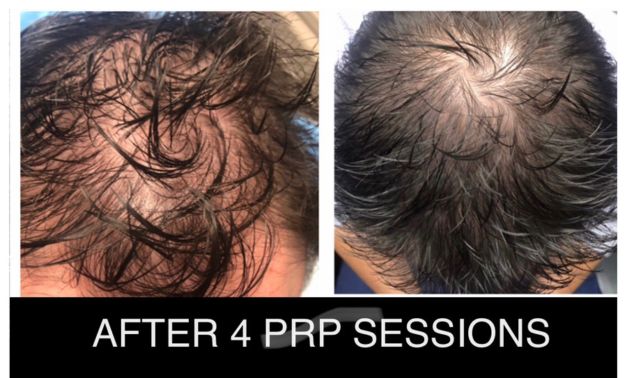 Hair Loss Injections Victoria Park Medispa Winnipeg Manitoba Canada