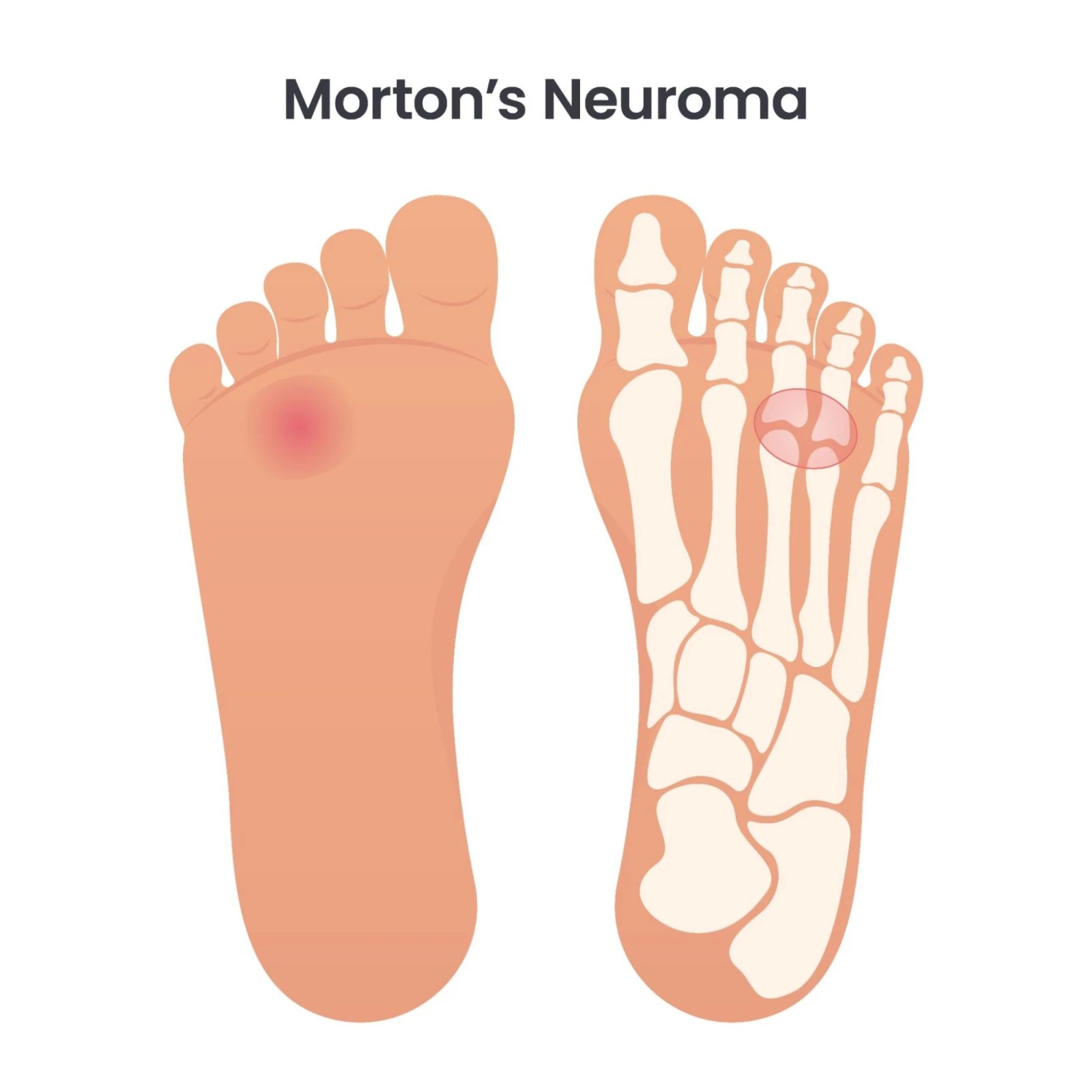 Recognizing Morton's Neuroma Symptoms and Relief