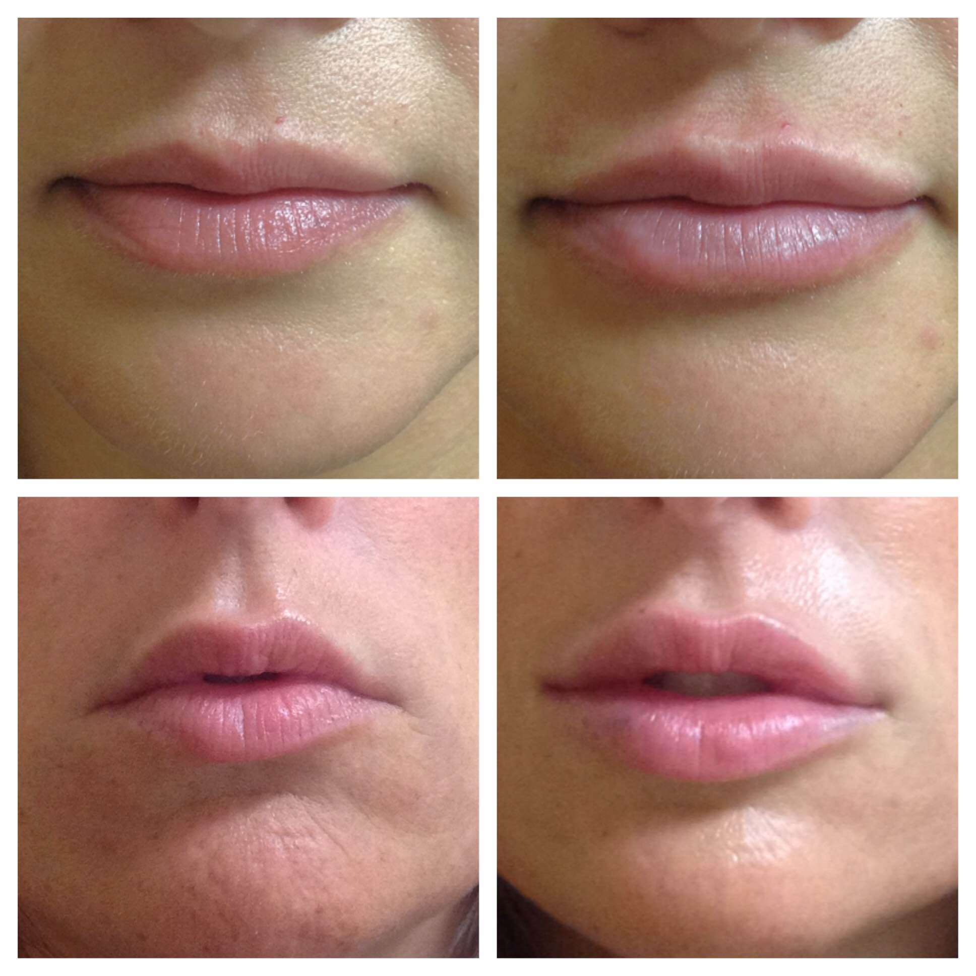 Lips Filler