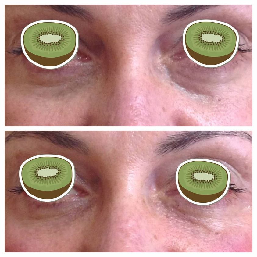 Under Eye Filler
