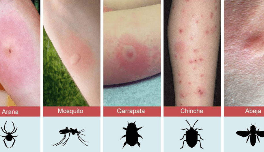 Cómo identificar una picadura de insecto y qué hacer con