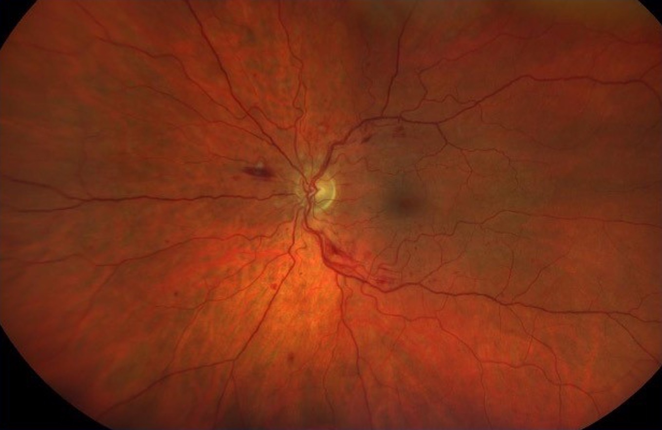 Hypertensive Retinopathy Silver Wiring