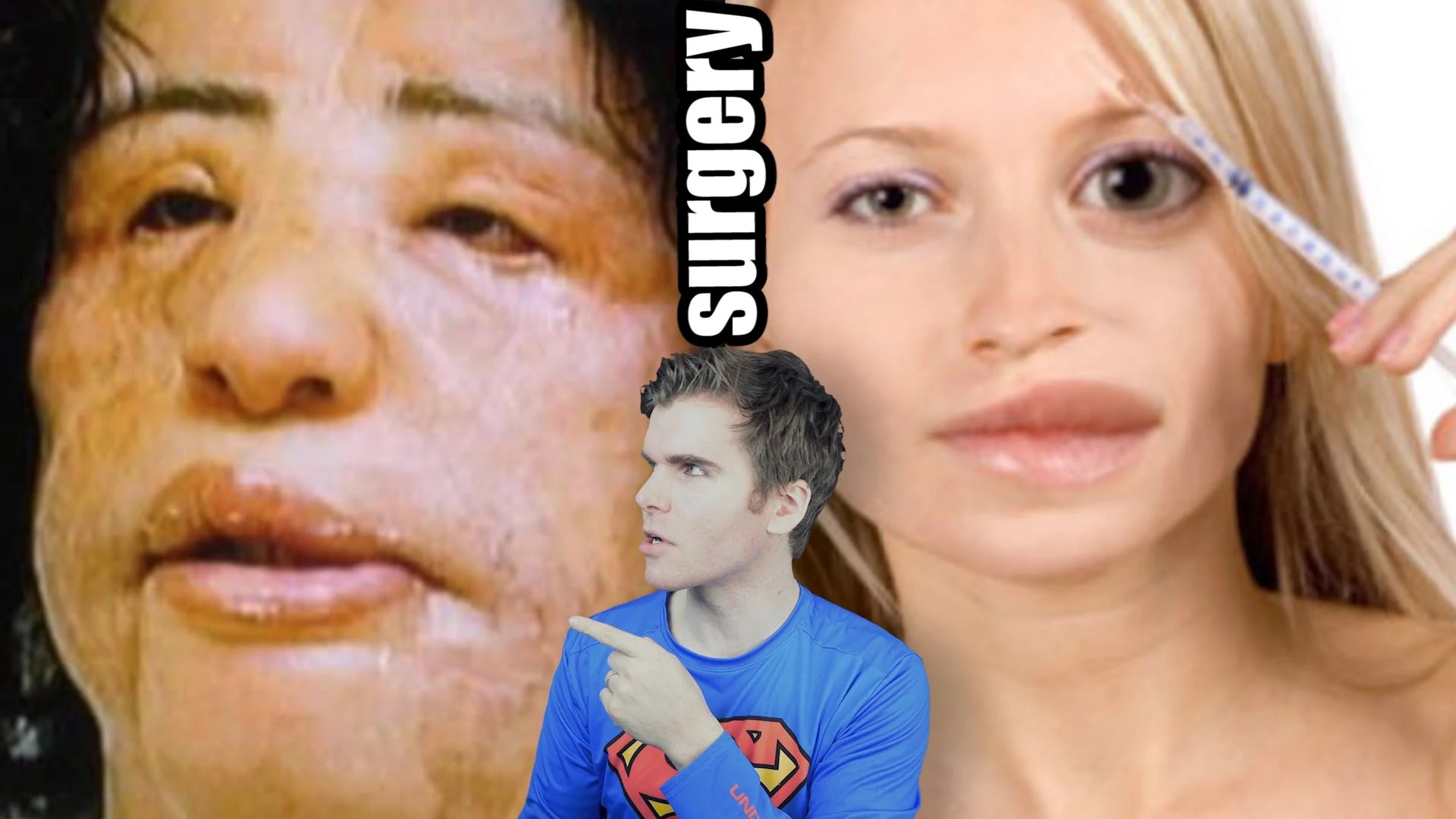 Plastic Surgery Gone Wrong (Before And After) Onision Wiki Fandom(020)