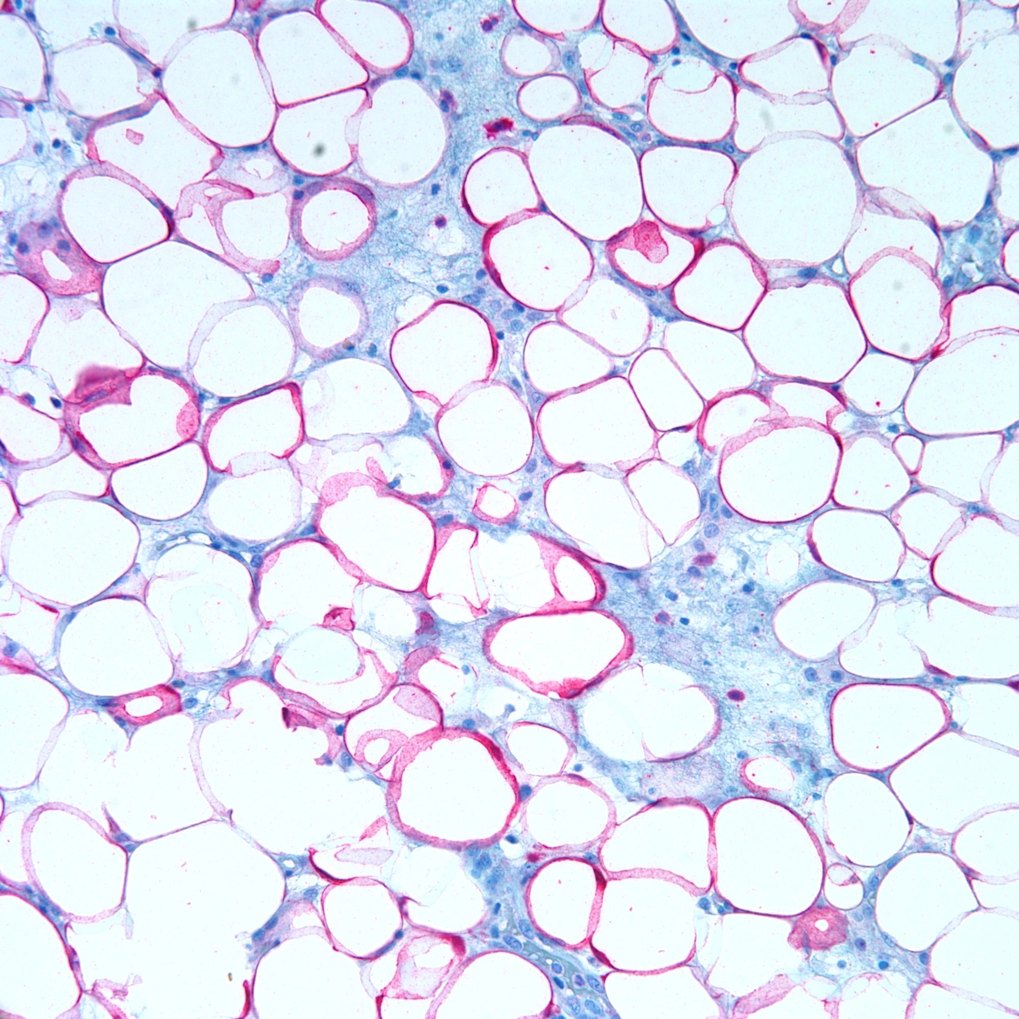 Image - S100.red.adipose tissue.200x.jpg | Pathology Resident Wiki
