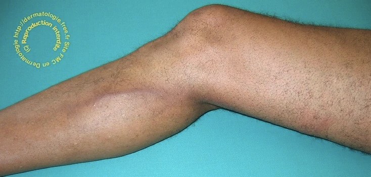 signe clinique de l'infection