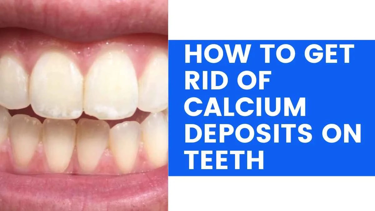 How To Get Rid Of Calcium Deposits On Teeth A Comprehensive Guide In 2023