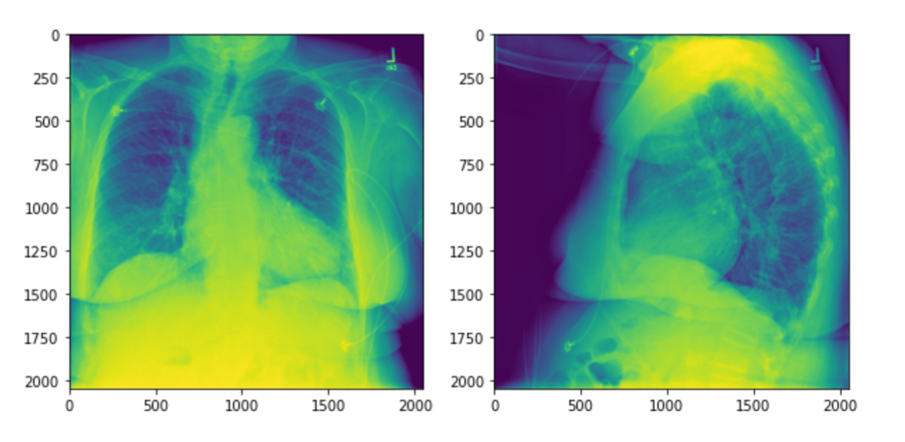 Radiology Report Generation for Chest XRAY Images Vijay S. Kalmath
