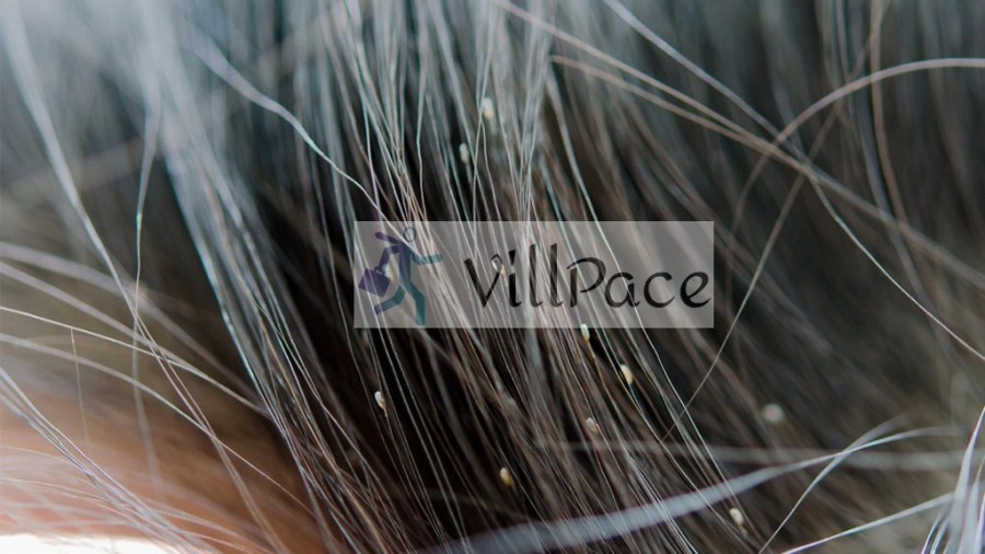 What Do Nits Look Like In Blonde Hair?